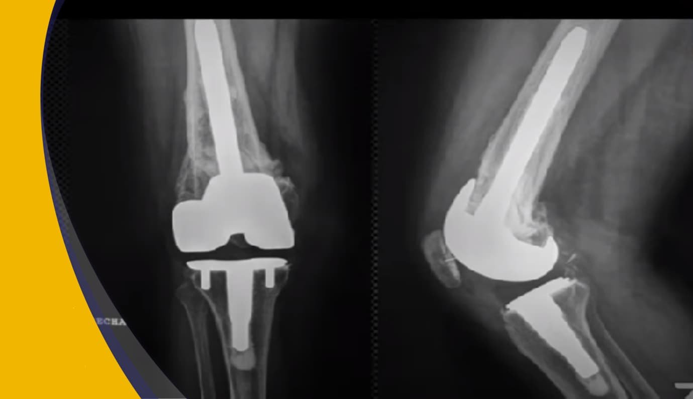 Artroplastia de rodilla: El alivio definitivo para el dolor