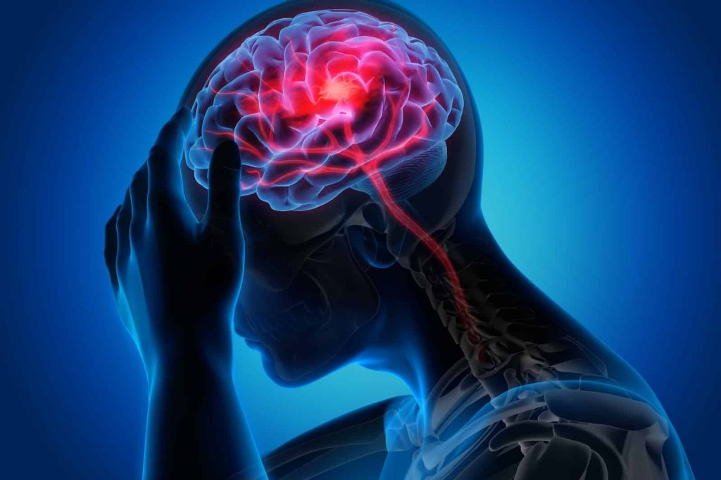 Accidente Cerebrovascular Origen S Ntomas Causa