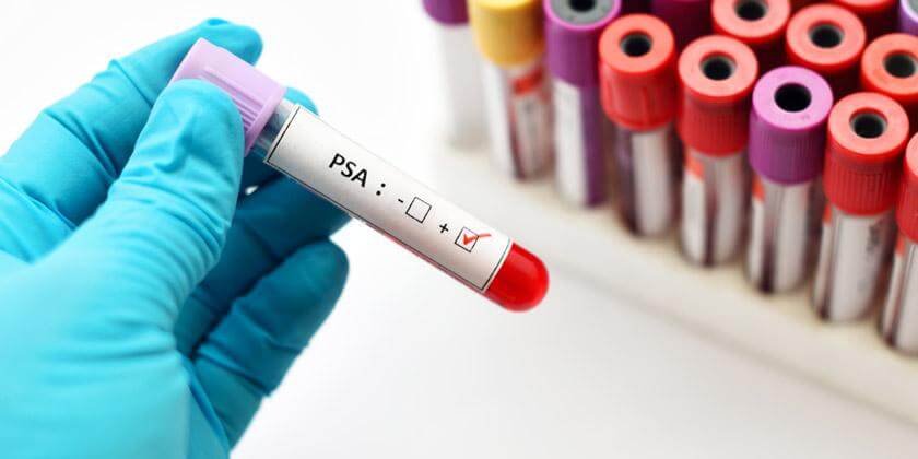 Las posibilidades de cáncer de próstata se incrementa en hombres por encima de los 50 años.