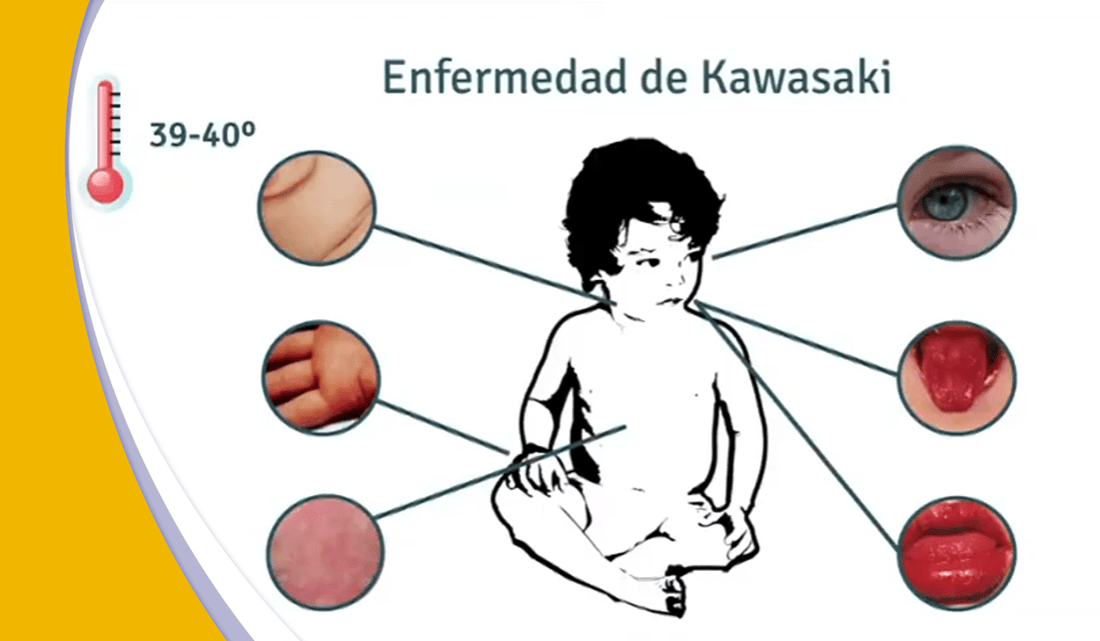 La Enfermedad de Kawasaki ¡Lo que sabemos!