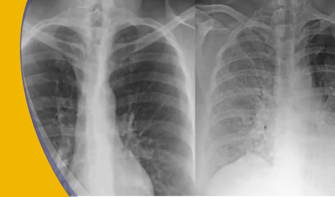 ¿Cómo ayuda la imagenología para diagnosticar COVID?