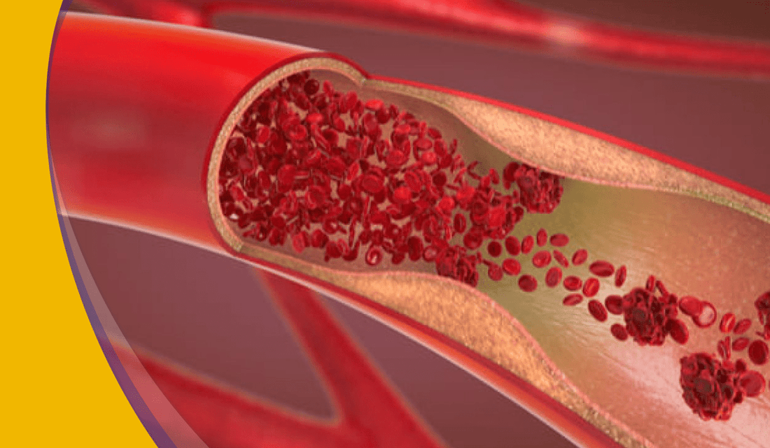 ¿Qué es el Síndrome Inflamatorio Multifactorial Pediátrico?