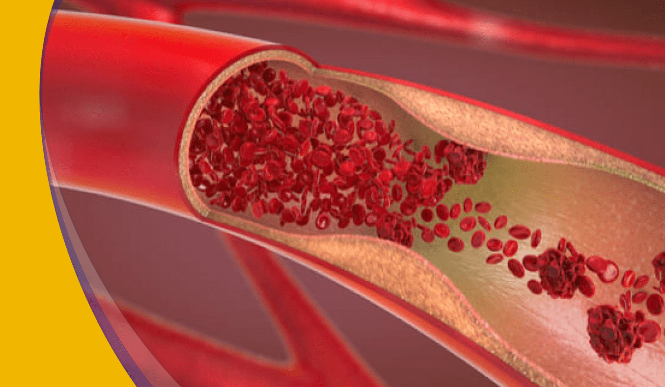 ¿Qué es el Síndrome Inflamatorio Multifactorial Pediátrico?
