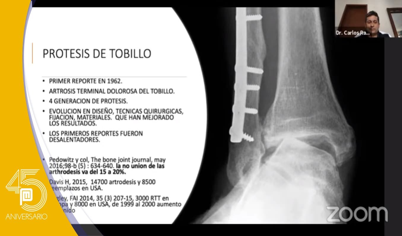 Actualidad en reemplazo articular de Tobillo