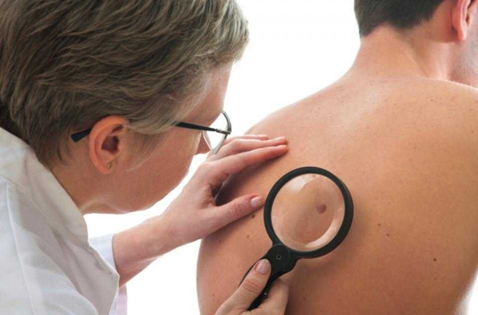 cáncer de piel