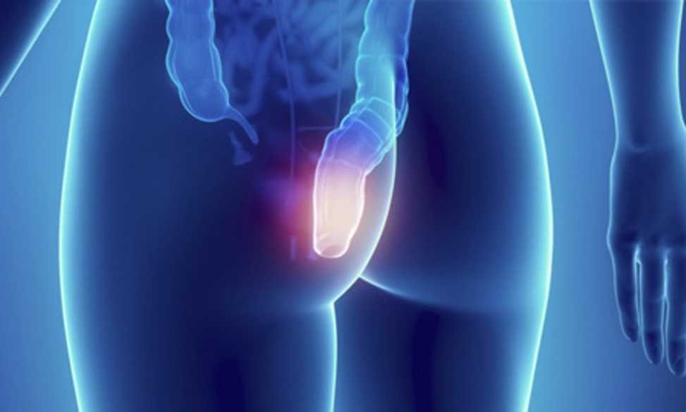 Hemorroides: ¿Qué son? ¿Por qué salen? ¿Cuáles son sus grados?