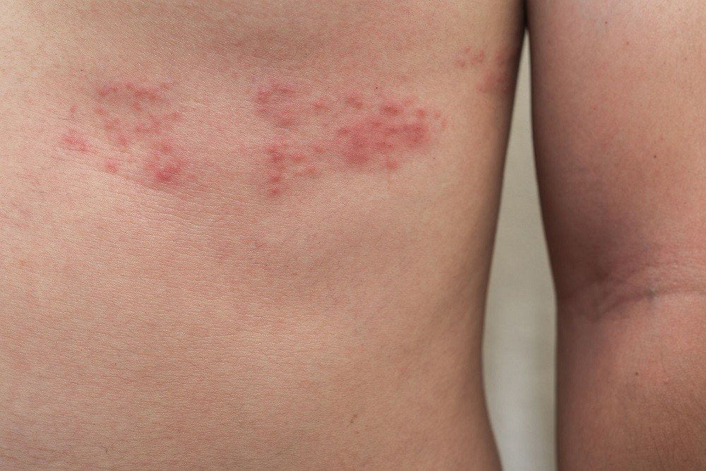 Culebrilla