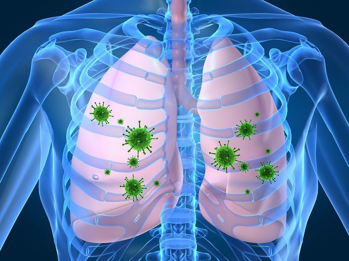 Neumonia