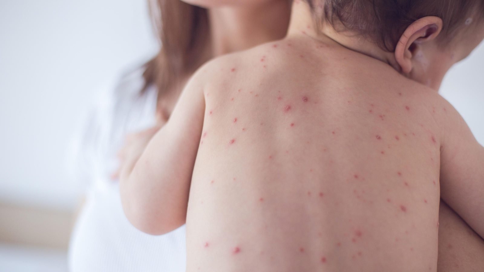 La Lechina o Varicela - Síntomas, cuidados y prevención