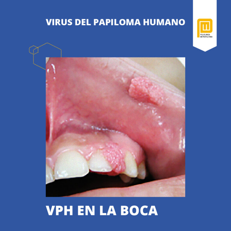 Virus Del Papiloma Humano Síntomas Y Tratamiento Policlínica Metropolitana 9900