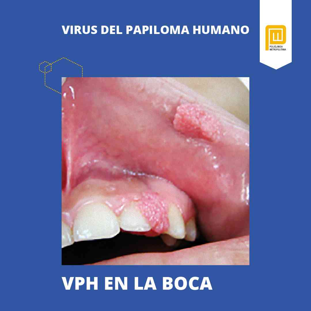 Virus del Papiloma Humano: y tratamiento -