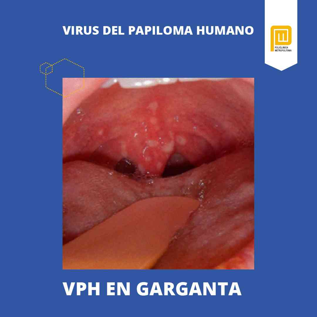 VPH en la garganta