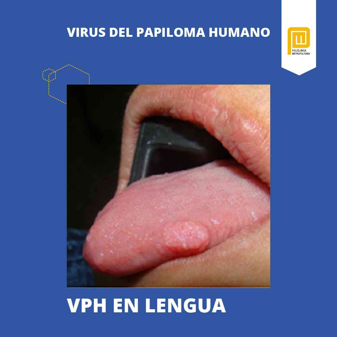Cobertizo compromiso mayor Virus del Papiloma Humano: Síntomas y tratamiento - Policlínica  Metropolitana