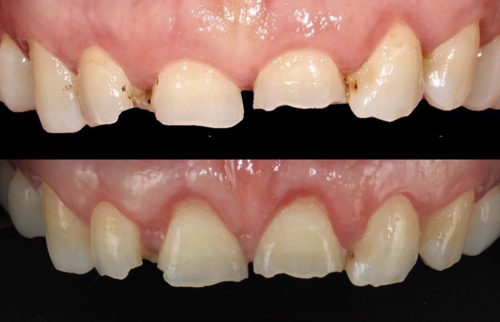 El apretar los dientes causa desgaste dental