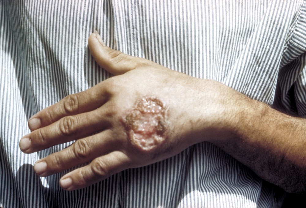 Leishmaniasis deteriora la piel