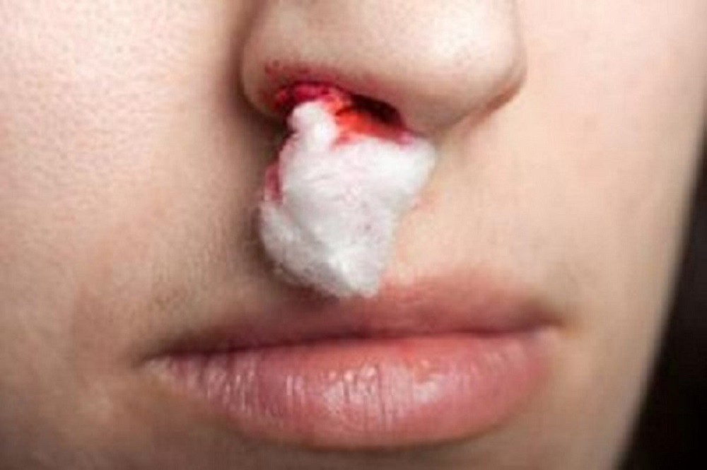 La difteria causa sangrado en a nariz