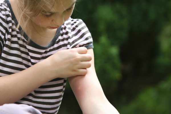 Niña rascándose la picada de un mosquito en un brazo