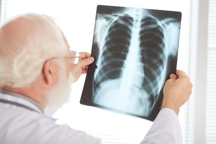 Las radiografías ayudan a ver lesiones en los pulmones