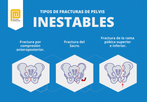 Tipos de Fracturas de Pelvis Inestables