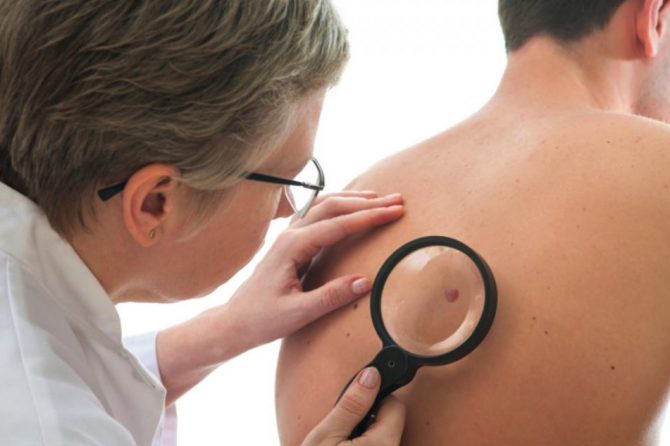 ¿Qué es el cáncer de piel y cómo se produce?