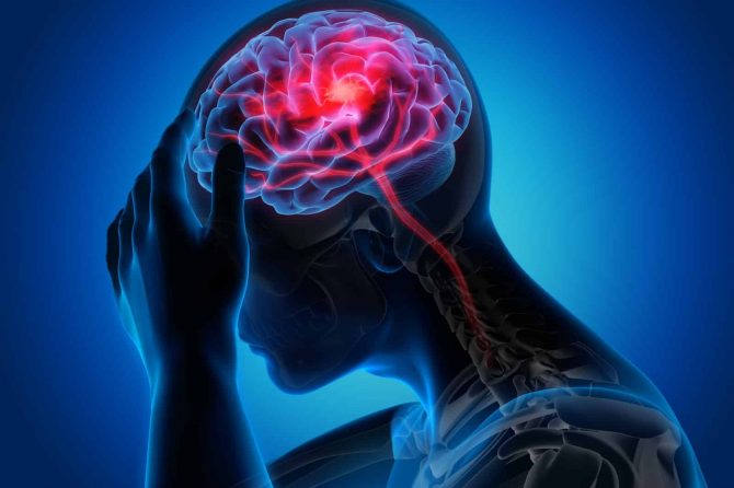 Accidente Cerebrovascular: Origen, síntomas, causa