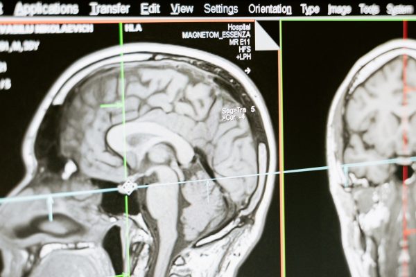 tomografia computarizada para diagnosticar acv