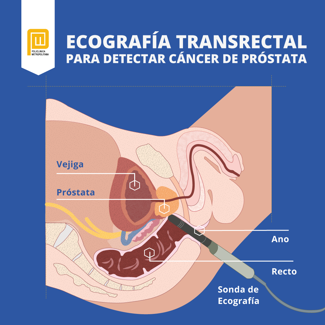 Ecografía transrectal para detectar cáncer de próstata