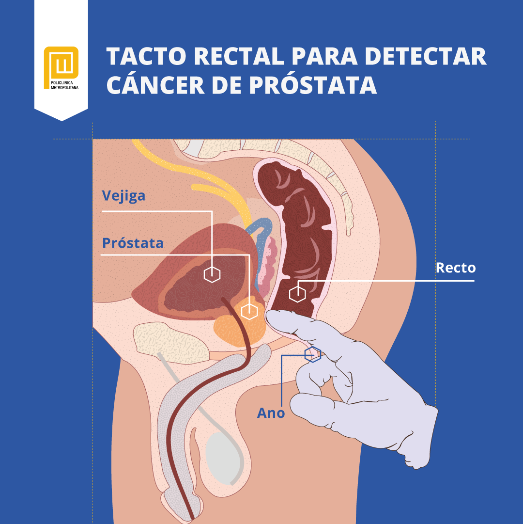Tacto rectal para examinar la próstata