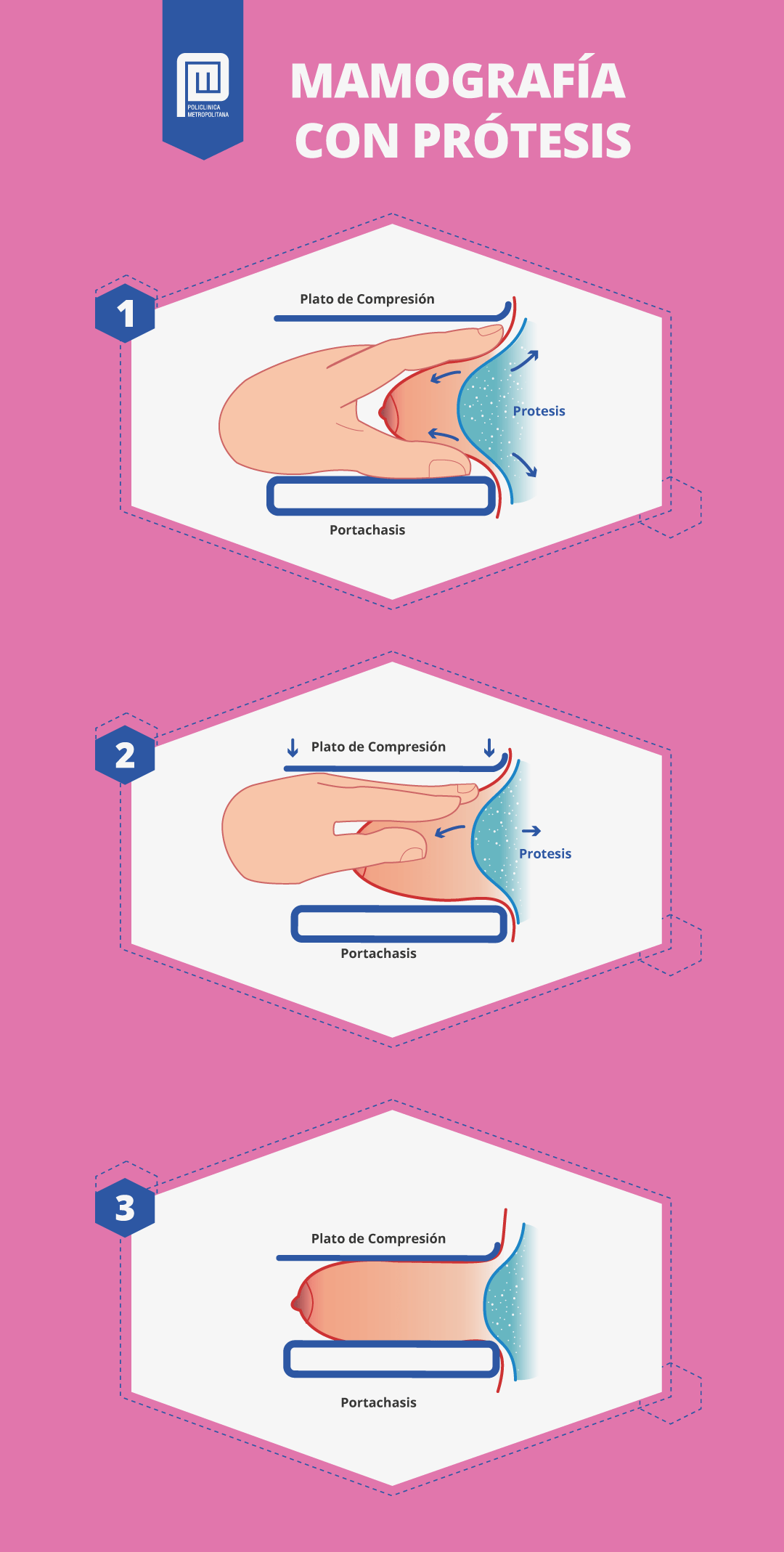 técnica de Eklund para prótesis mamaria