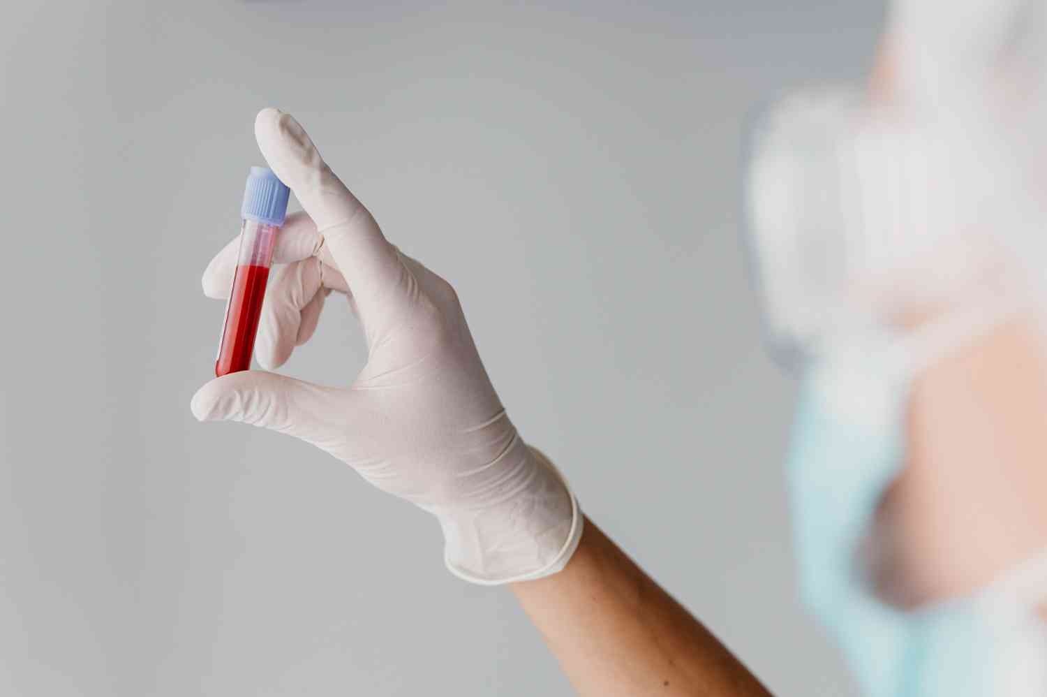 Un examen de sangre es necesario para el diagnóstico de anemia