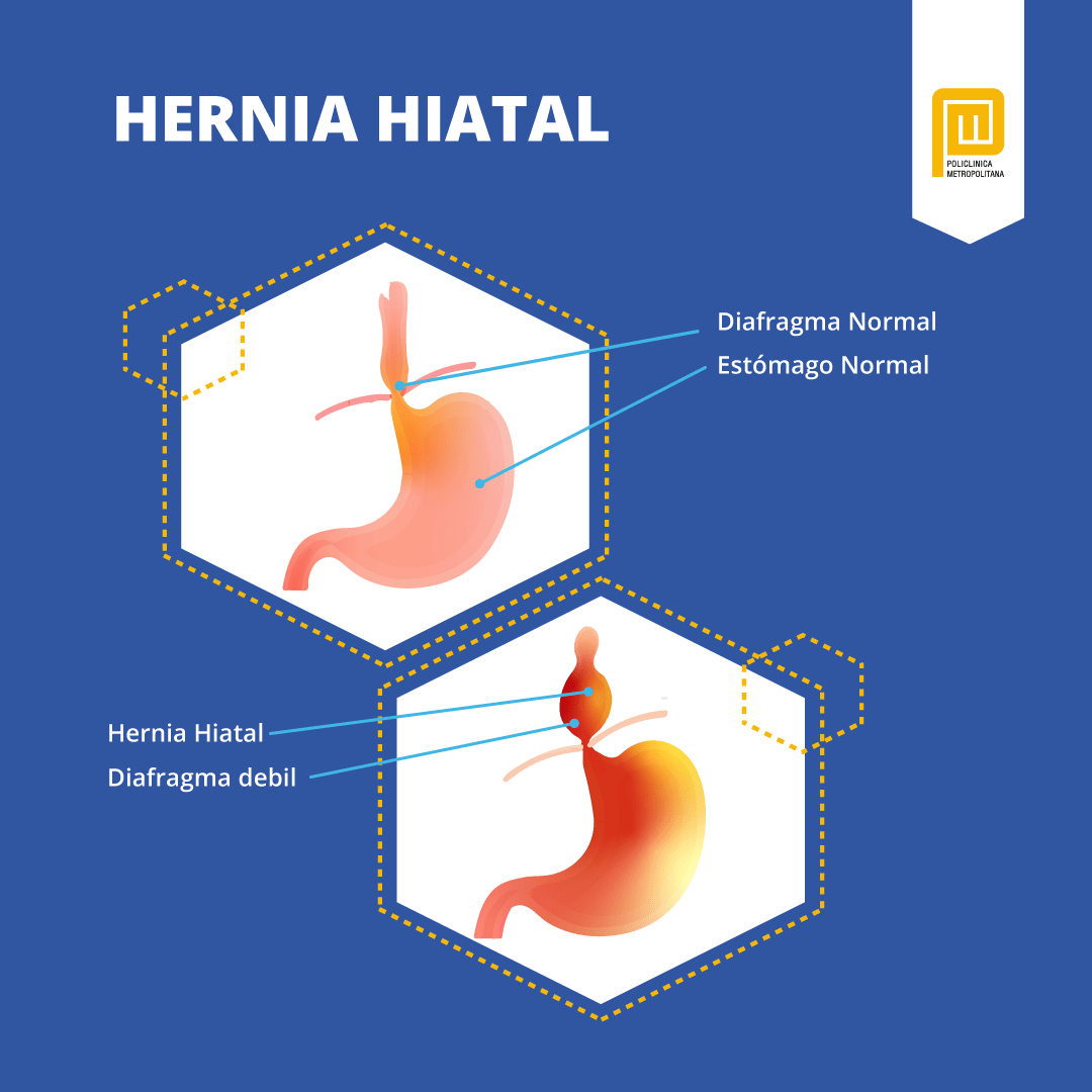 Hernia hiatal