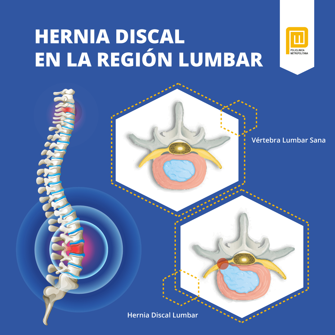 Hernia discal en la región lumbar