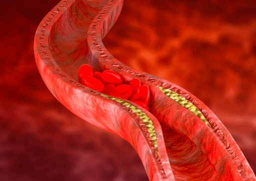 El colesterol LDL crea la acumulación de placa en las arterias