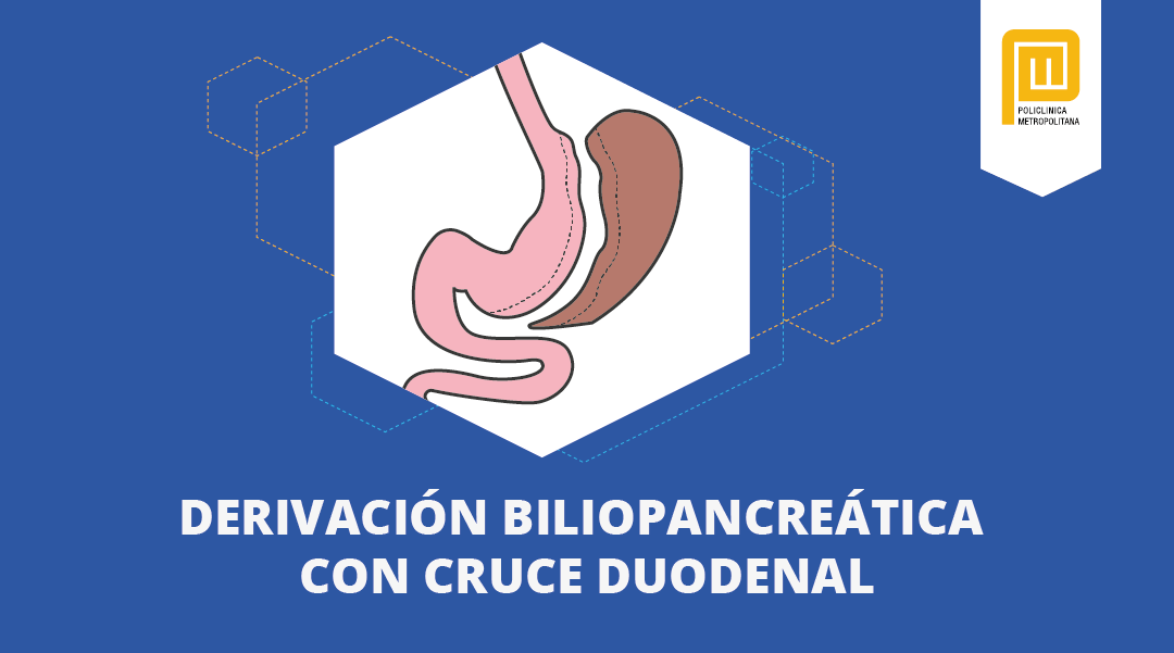 Derivación biliopancreática con cruce duodenal
